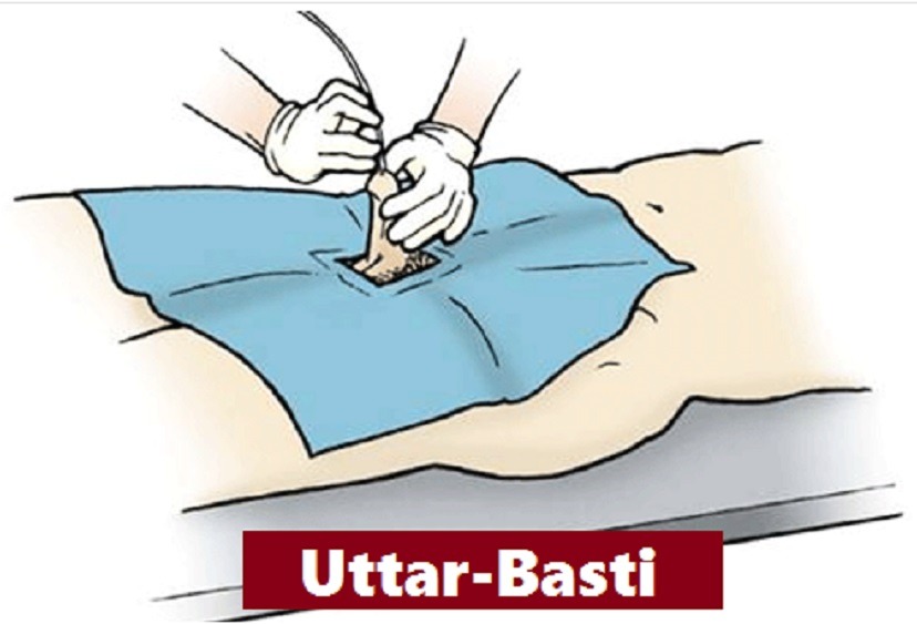 Uttar basti an Ayurvedic treatment, can also help with prostate enlargement