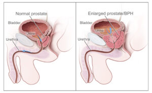 Benign prostatic hyperplasia- BPH) Enlarged Prostate