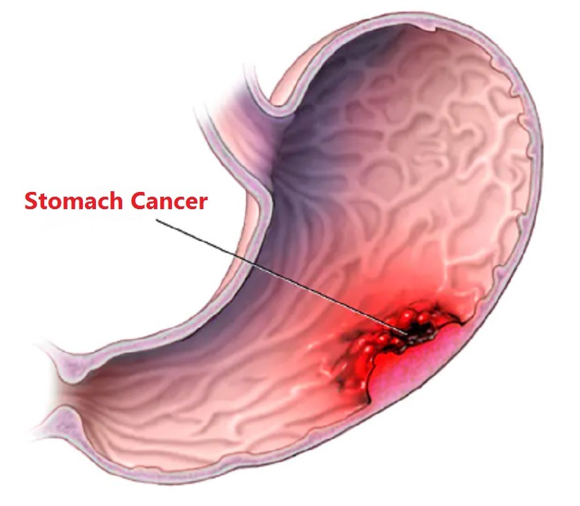 How to Avoid Stomach Cancer