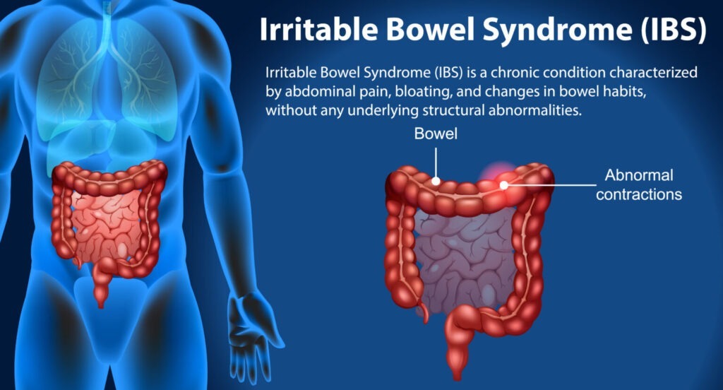 Irritable Bowel Syndrome (IBS)