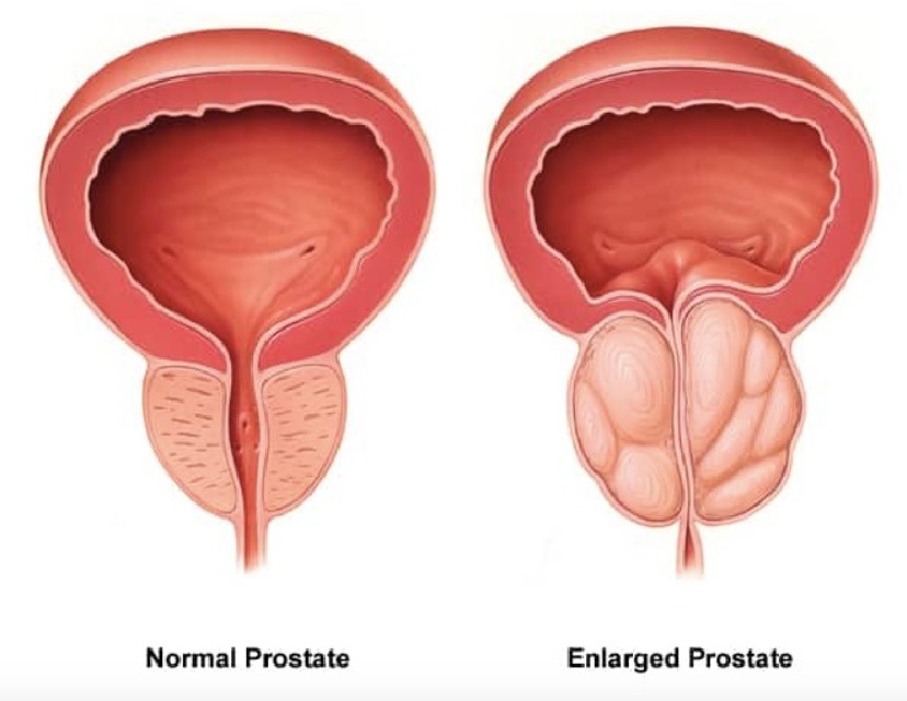 Benign prostatic hyperplasia- BPH) Enlarged Prostate