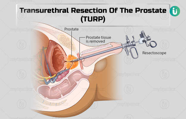 transurethral-resection-of-the-prostate-turp.jpg