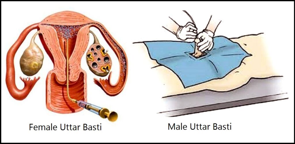 Uttar basti Uttarbasti